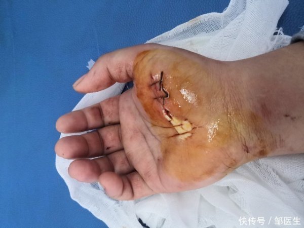 搭档网 皮肤一碰就淤青，小伤口止不住血，有这些情况一定查查这个病！