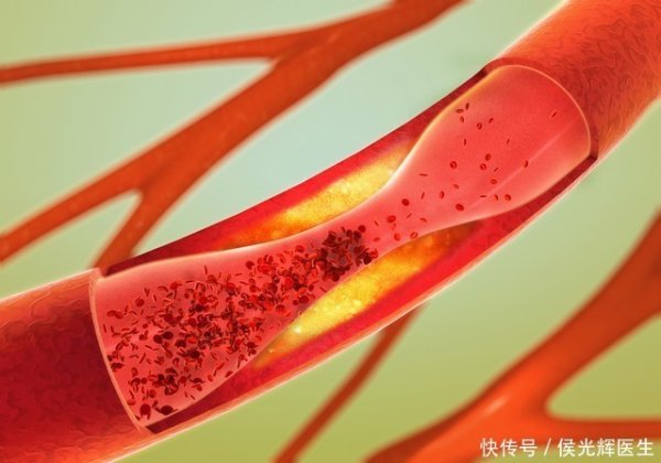 中股网 再次提醒：腿上有这种“红血丝”的人，可能是身体发出的信号
